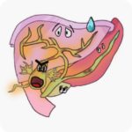 Drawing of the liver, pancreas and inflamed gallbladder